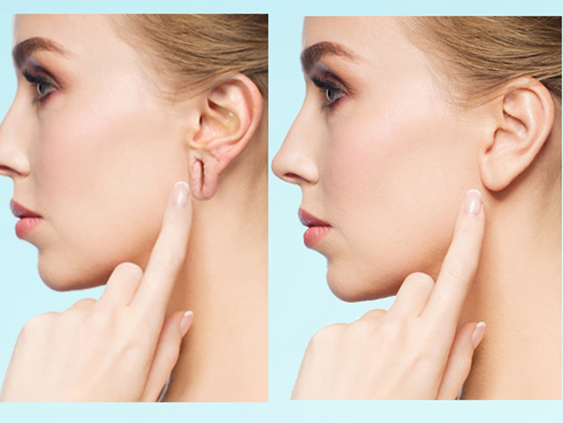 Ear lobe repair