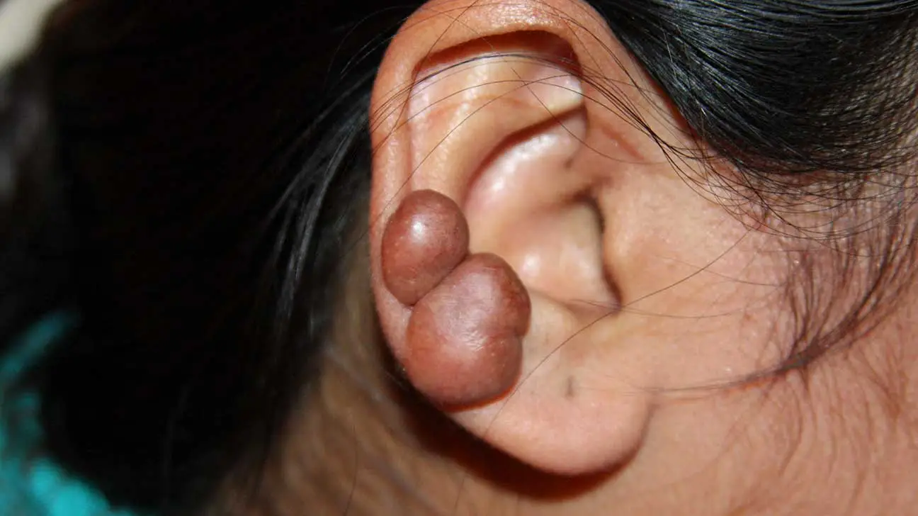 Keloid on ear