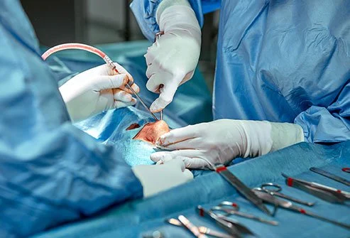 Nasal mass excision