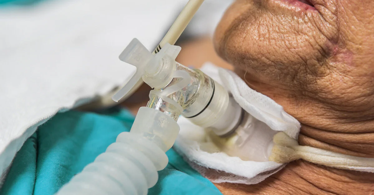 Tracheostomy