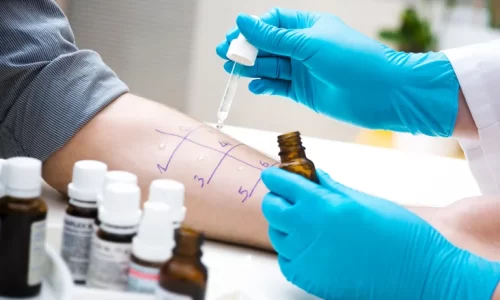 Skin prick allergy testing