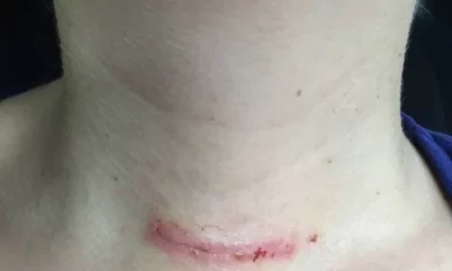 Thyroidectomy